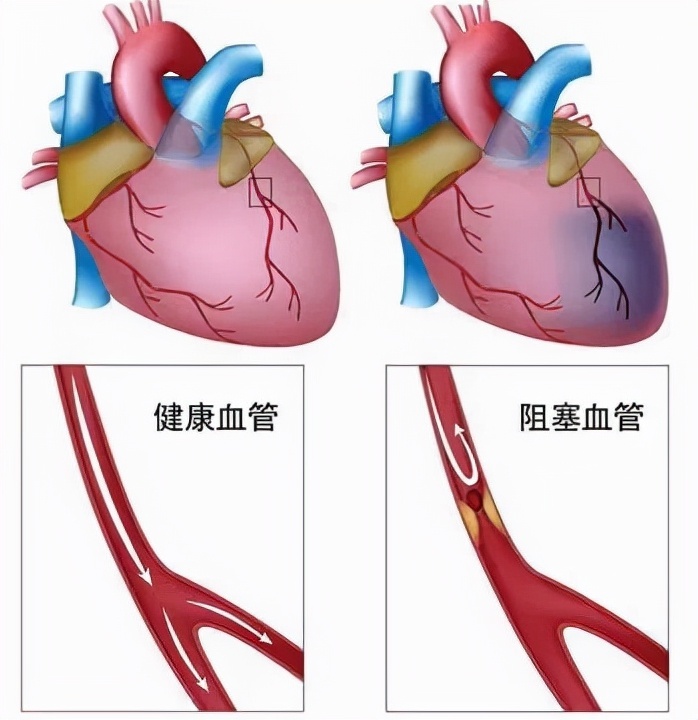 揭秘前沿！心脏血管阻塞突破性开通技术全新突破